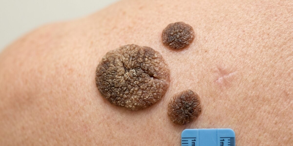 Clínica Sanipiel - Manchas y Lesiones Cutáneas Madrid - Queratosis