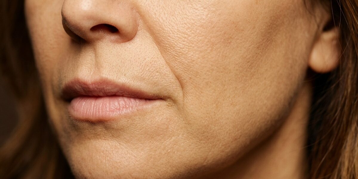 Clínica Sanipiel - Tratamiento Sculptra - Madrid - Surcos